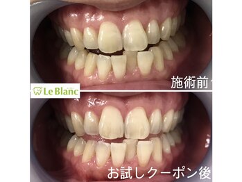 ルブラン 奈良店(Le Blanc)/回数を重ねて白く