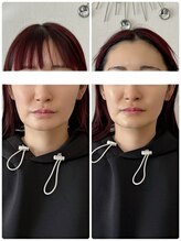 メディカルエース(MedicalAce)/リフトアップへ