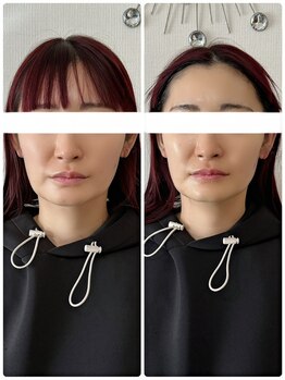 メディカルエース(MedicalAce)/リフトアップへ