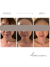 ハリムーン 仙台(harimoon)/美容鍼灸ビフォーアフター