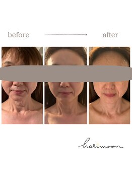 ハリムーン 仙台(harimoon)/美容鍼灸ビフォーアフター