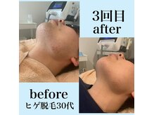 メンズ シャンティ(Men s SHANTI)の雰囲気（青ヒゲ卒業宣言!！【結果に自信あり】脱毛は当店にお任せ下さい）