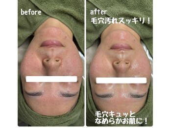 クラリ(Clari)/毛穴/毛穴洗浄/ハイドラ