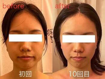 ビーキュート 神戸元町店(BE-CUTE)/小顔コルギ10回