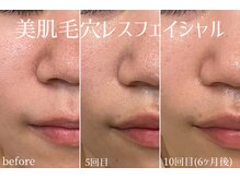 ハティア(hattia)/ざらつき毛穴解消！美肌を育てる