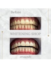 ホワイトニングショップ 尼崎店/セルフホワイトニング1回の効果