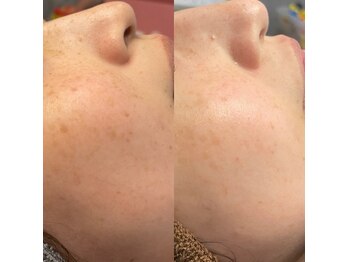 モルセラ(Moluccella)/4回の施術