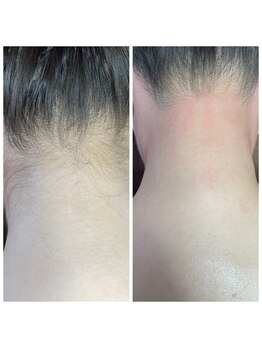 ルアナ(Luana)/【Before/after】シュガーリング