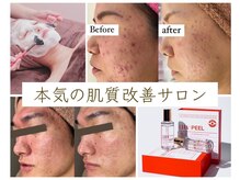 ホワイトアクア 天王寺本店(WHITE AQUA)の雰囲気（エステが初めての方もピーリング専門店にお任せください！）