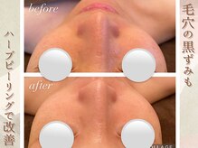 ラナ(LaNa)/毛穴の黒ずみ撃退