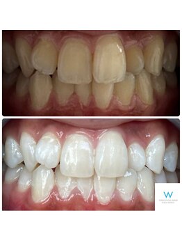 ホワイトニングショップ 奈良生駒店/想像以上の白さへ