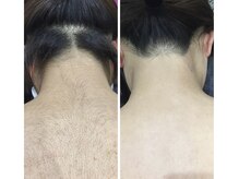 ハダハダ(HADA HADA Medical Esthetic)の雰囲気(見えないうなじや背中もお任せください)