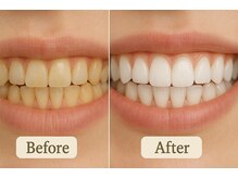 セルフホワイトニング／8分照射×2／デート／ブライダル