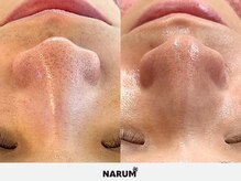 ナルムフェイシャル 代々木(NARUM facial)/毛穴洗浄