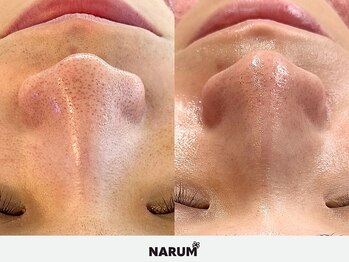 ナルムフェイシャル 代々木(NARUM facial)/毛穴洗浄