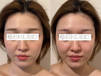 エクボ 立川店(EKUBO)の写真/初回1度でこの効果!!左右差を整え、血色感と艶めき溢れるお顔へ☆小顔と美肌を同時に叶える極上ケア！