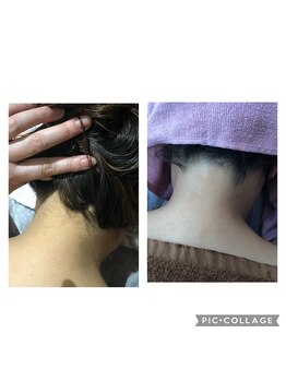 サロンシャイン(Salon Shine)/うなじ脱毛50代女性