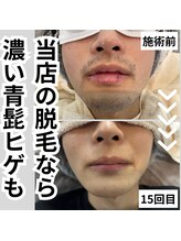 ガランテリー 御殿場店/濃い青髭もヒゲ脱毛で解消