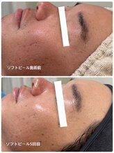 ピーロ(PiiiLO)/施術例/ソフト4回+ディープ1回