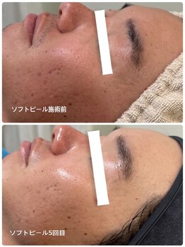 ピーロ(PiiiLO)/施術例/ソフト4回+ディープ1回