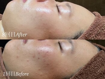 ディアーム 光明池店(Diarm)/REVI陶肌トリートメント8回目