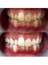 ワールドビューティー(World Beauty)/18歳/ホワイトニング　6回