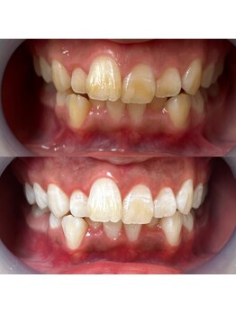 ワールドビューティー(World Beauty)/18歳/ホワイトニング　6回