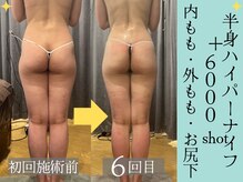 スリムプロ 天王寺店(Slimpro)/半身ハイパーナイフ＋6000shot