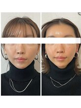 メディカルエース(MedicalAce)/ハイサーマ