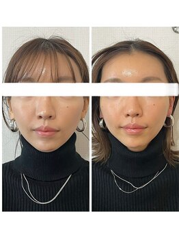 メディカルエース(MedicalAce)/ハイサーマ