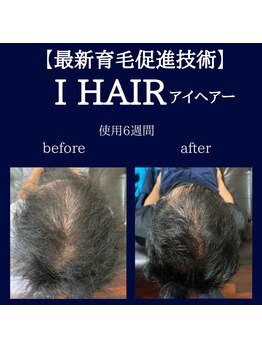 デン(DEN)/育毛促進　ビフォーアフター