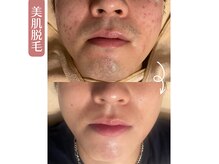 ビモット(Bemott)の雰囲気(痛みを抑え、肌荒れを改善しながら早い脱毛を目指します☆)