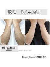 エミルカ(EMILUCA)/メンズ両腕脱毛