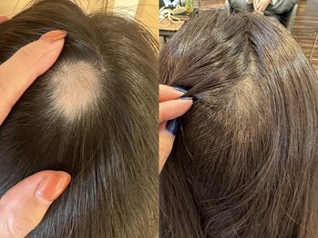 ルー ハナレ 神戸岡本 摂津本山店(Luu HANARE)/育毛促進毛のハリコシ/白髪/脱毛