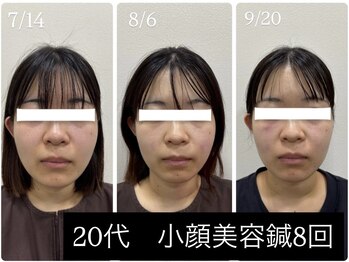 ラムーン(La.Moon)/小顔・美容鍼8回