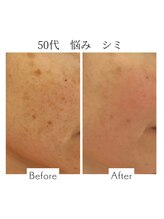 ファニービー 吹田店/50代 シミ 8ヶ月で改善