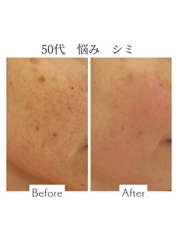 ファニービー 吹田店/50代 シミ 8ヶ月で改善
