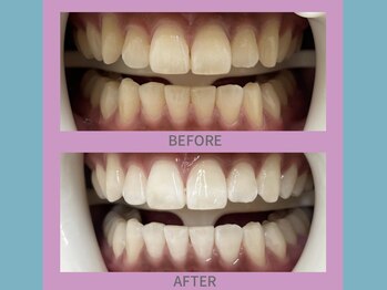 ココティ ホワイトニング(Cocotii)/ビフォーアフター