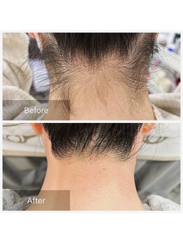 アート 熊本並木坂店(ART)/うなじ脱毛/フラッシュワックス