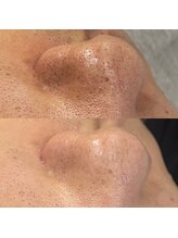 スイ 四条烏丸(SUI)/〇毛穴洗浄