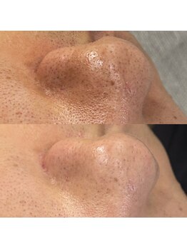 スイ 四条烏丸(SUI)/〇毛穴洗浄