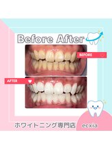 エクシアホワイトニング 札幌中島公園店/BeforeAfter［ホワイトニング］ 