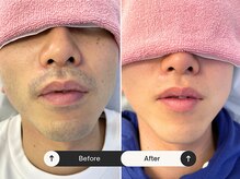 パッソ(Passo)/メンズ脱毛サロンPasso ビゲ脱毛