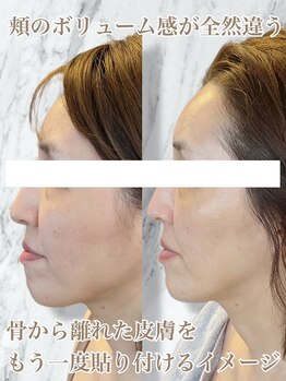 ルミライ(Lumirai)/たるみ改善|毛穴|フェイシャル