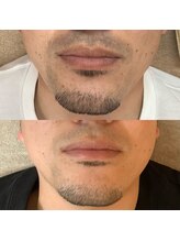 エステ ド モモコ/メンズヒゲ脱毛