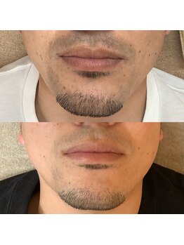 エステ ド モモコ/メンズヒゲ脱毛