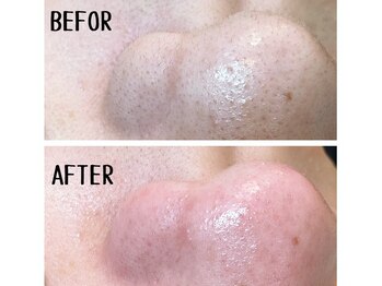 メンズプシュケ(men's PSYCHE)/毛穴エステ