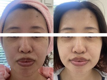 サクラ 本厚木駅前店(SAKURA)/【本厚木/シミケア/たるみケア】