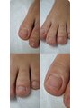 ルーチェネイル(LUCE .nail)&nbsp;一度で痛みが改善されるおすすめメニュー！巻爪ケアお任せ下さい