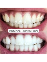 ホワイトニングラボ(Whitening Labo)/ビフォーアフター